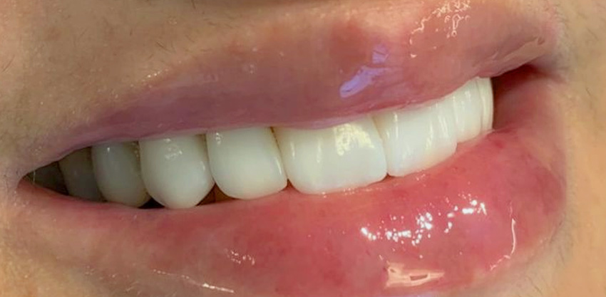 Facetas de emax: leveza e naturalidade ao seu sorriso