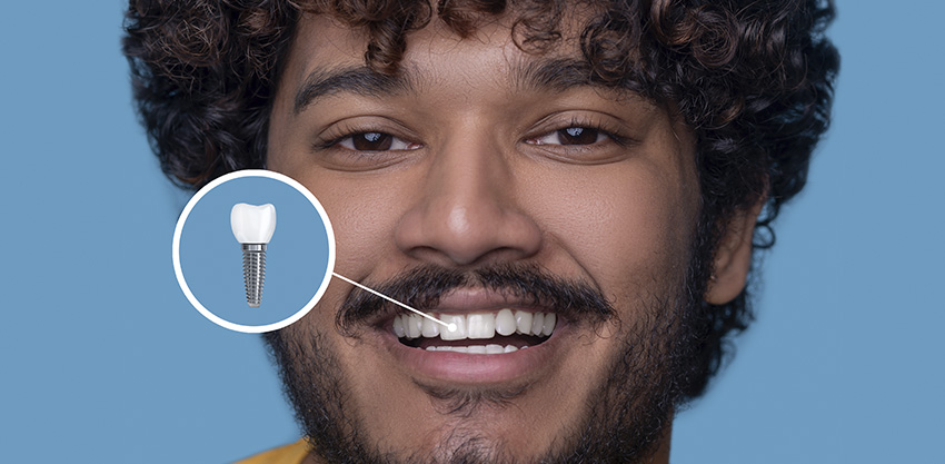 O que é um implante dentário?