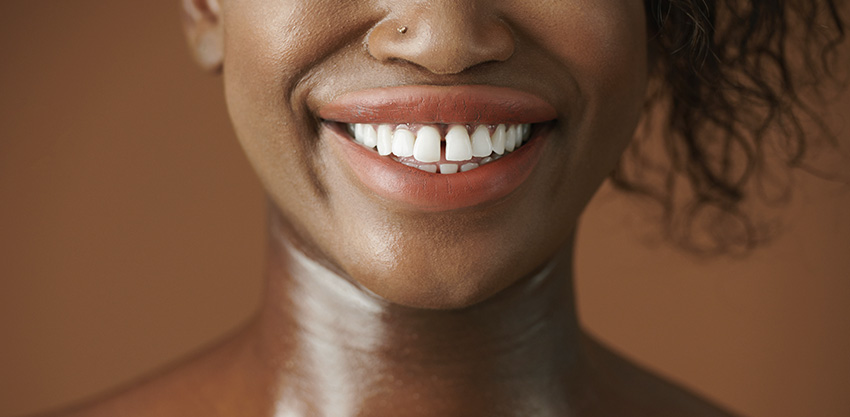 Vergonha do seu diastema?